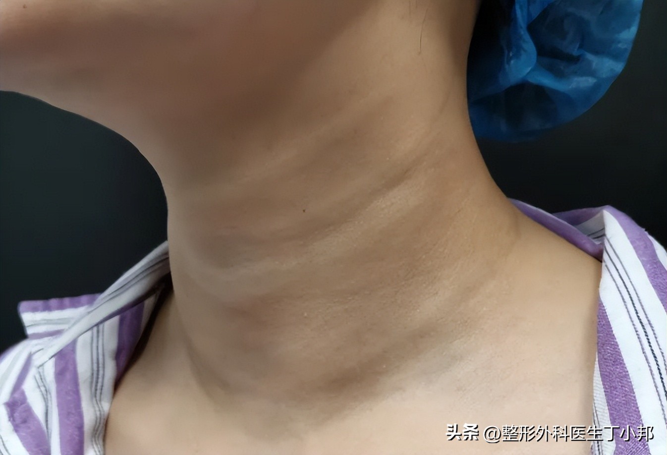 填充颈纹后变白色条怎么消除,颈纹玻尿酸填充