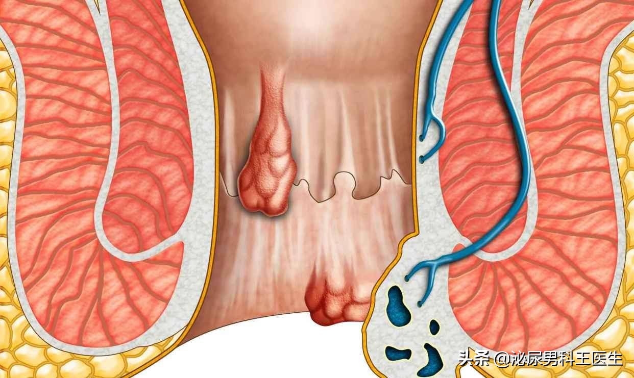 肛门潮湿发痒是什么病,肛门潮湿瘙痒是什么病怎样治愈