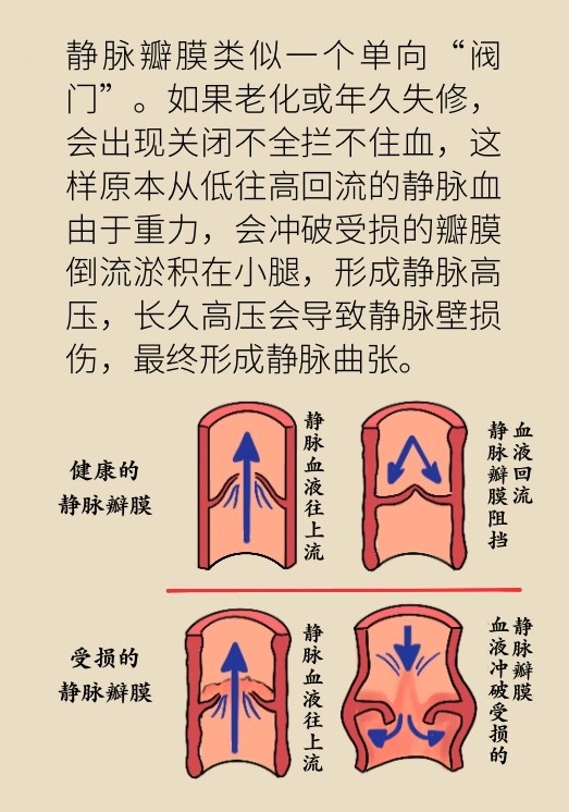 静脉曲张能自愈吗,静脉曲张0级到6级图片