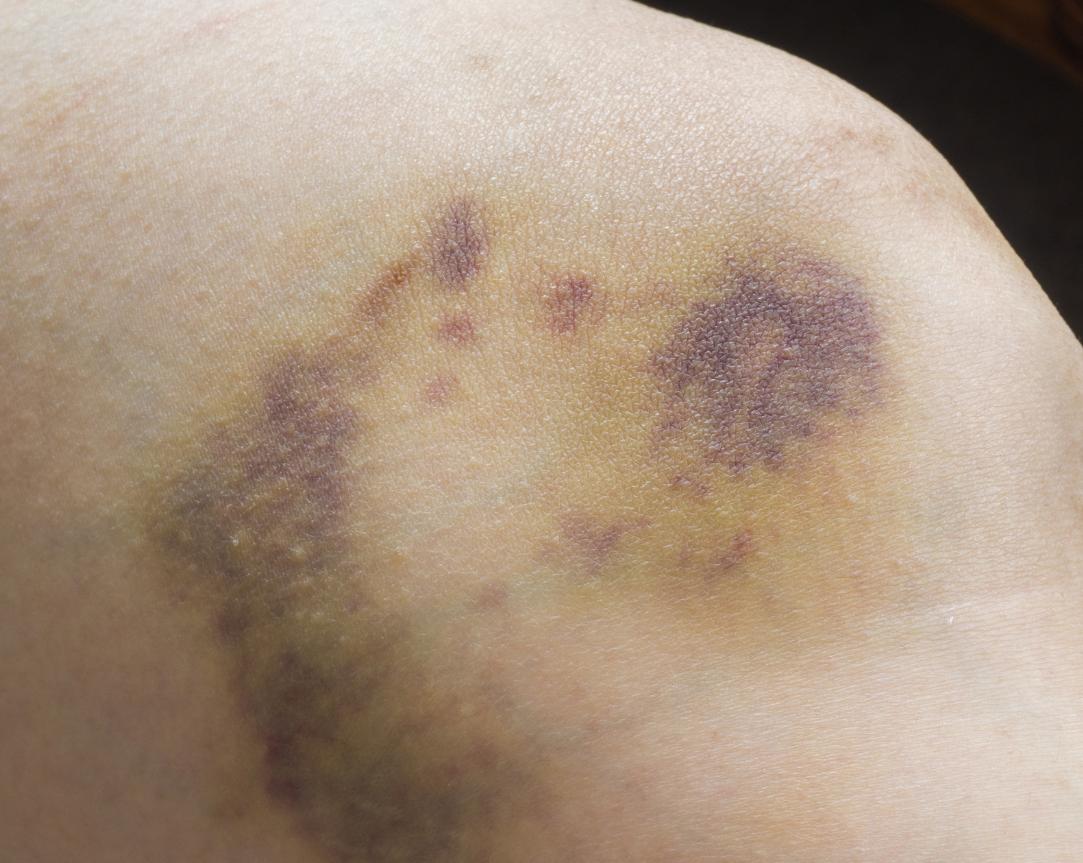 肝脏出问题皮肤痒是什么样子,肝脏疾病引起的皮肤瘙痒如何医治