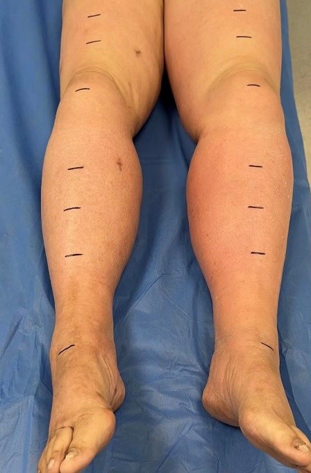 淋巴水肿犯丹毒了吃什么药,治疗丹毒水肿的绝招