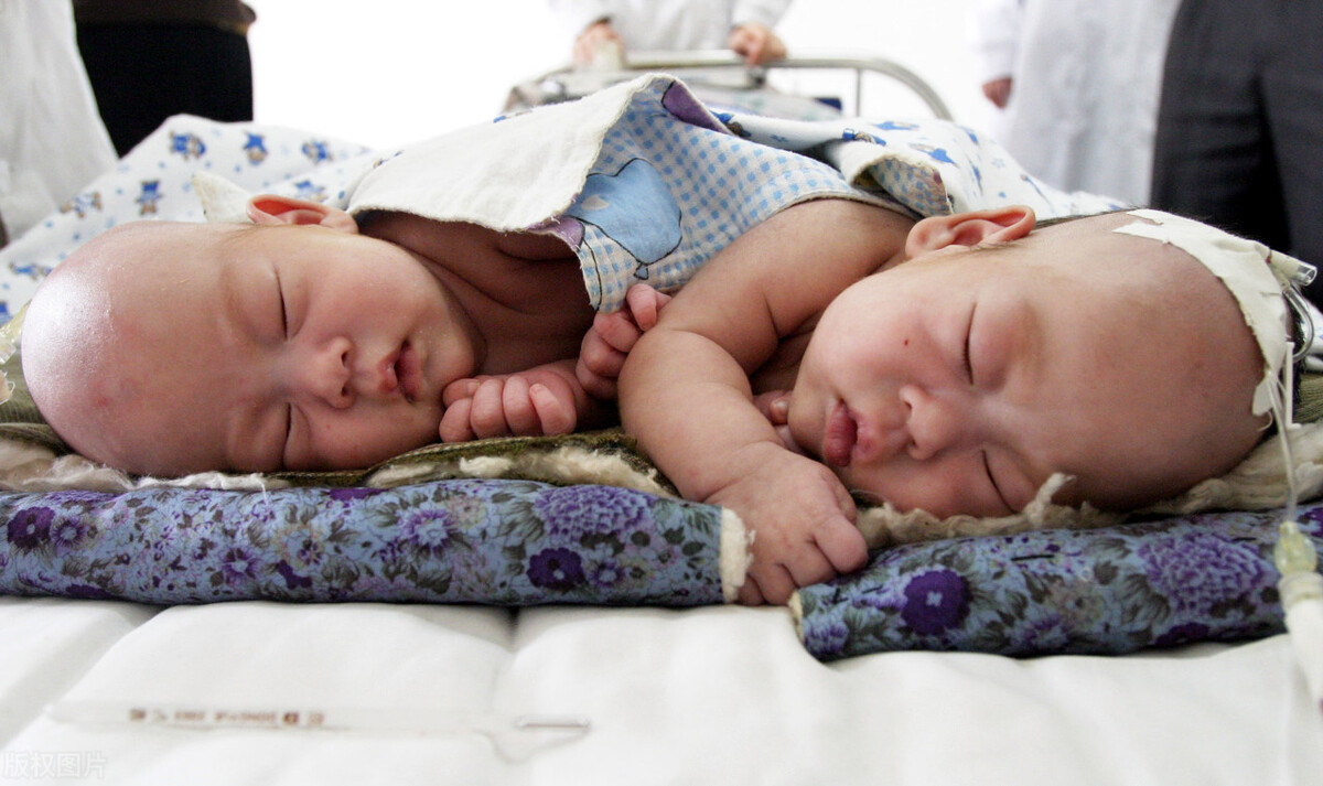 双头人连体姐妹怎样结婚,连体双头姐妹怎么结婚