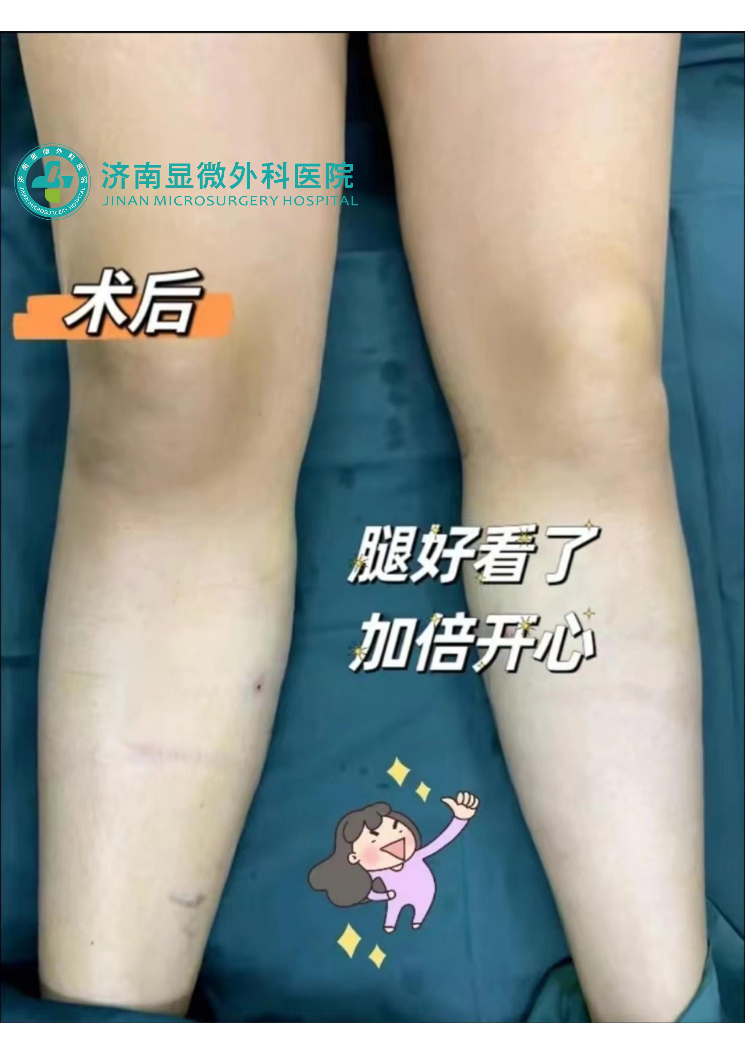 静脉曲张蚯蚓腿吃什么药,腿有静脉曲张怎样锻炼才好呢