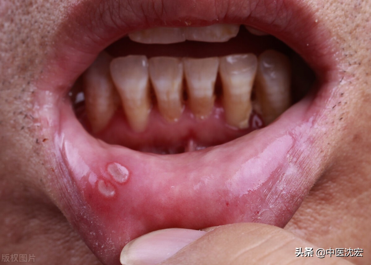 口腔溃疡最见效的泻火方法,口腔溃疡去火用药