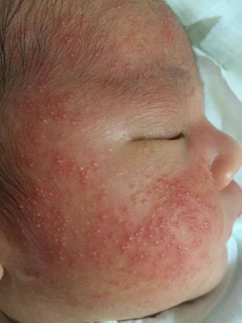 宝宝湿疹反复发作一招解决,宝宝湿疹反复发作如何应对