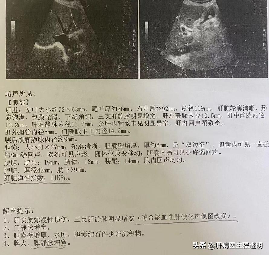 心源性肝硬化失代偿还能活多久,治疗心源性肝硬化腹水最好的中医