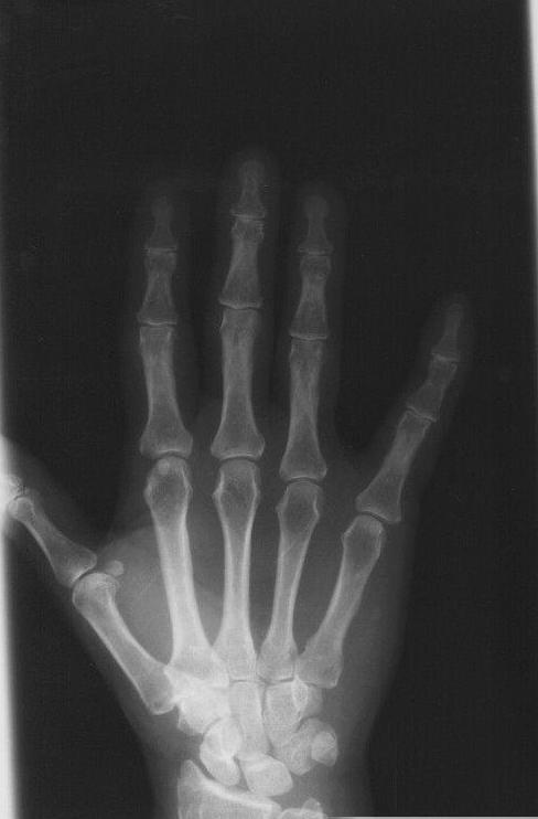 骨折之后有大量骨痂是完全好了吗,骨折后不疼了是不是好了