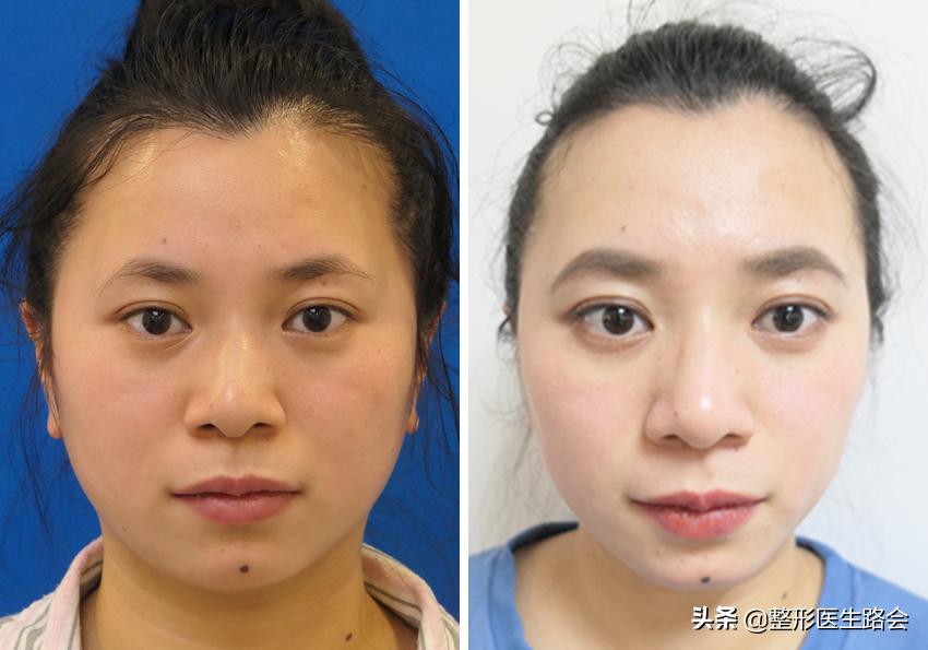 瞒着老爸，在北京隆下巴：22岁东*姑北**娘80天甩掉“肉乎乎包子脸”