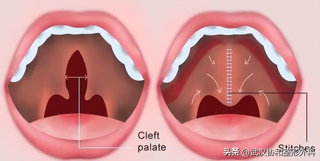 唇腭裂做一次手术就好了吗,唇腭裂一次性做完鼻子好吗
