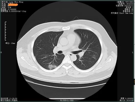 新冠复阳会感染吗,新冠复阳还是二次感染