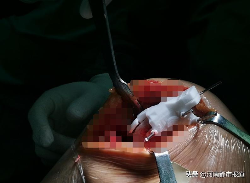 全球首例3d打印距骨表面假体置换,首例医生3d打印距骨表面植入人体