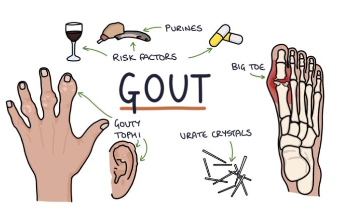 痛风反复发作中医怎么调理,痛风中医怎么调理代谢功能