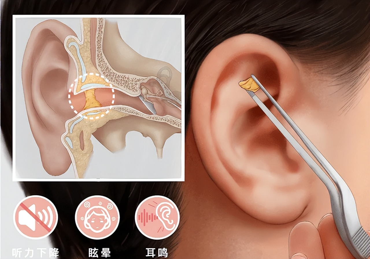 耳朵里面发痒怎么回事怎么去治疗,耳朵里面有黄色分泌物有臭味发痒