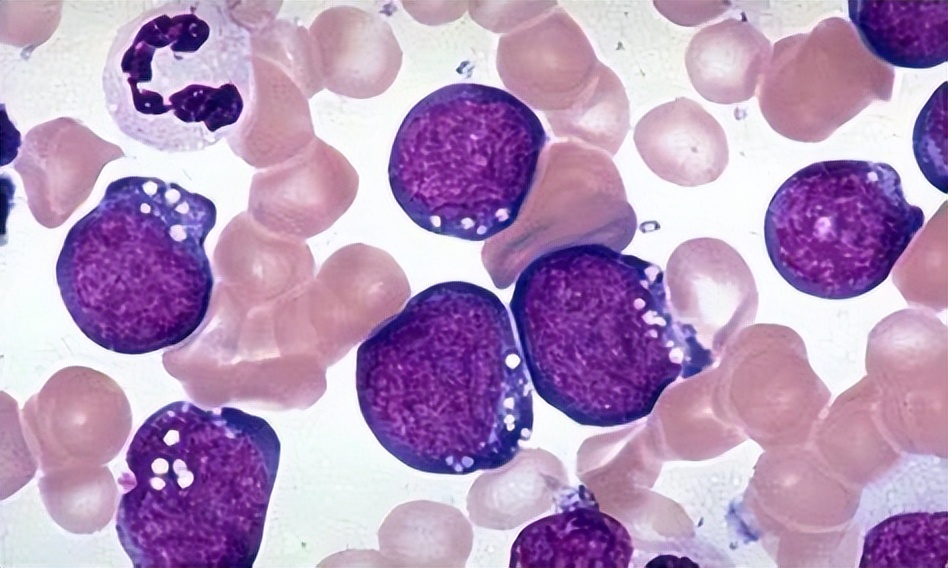 血常规检查各项指标都高什么原因,血常规四个指标升高需要注意什么