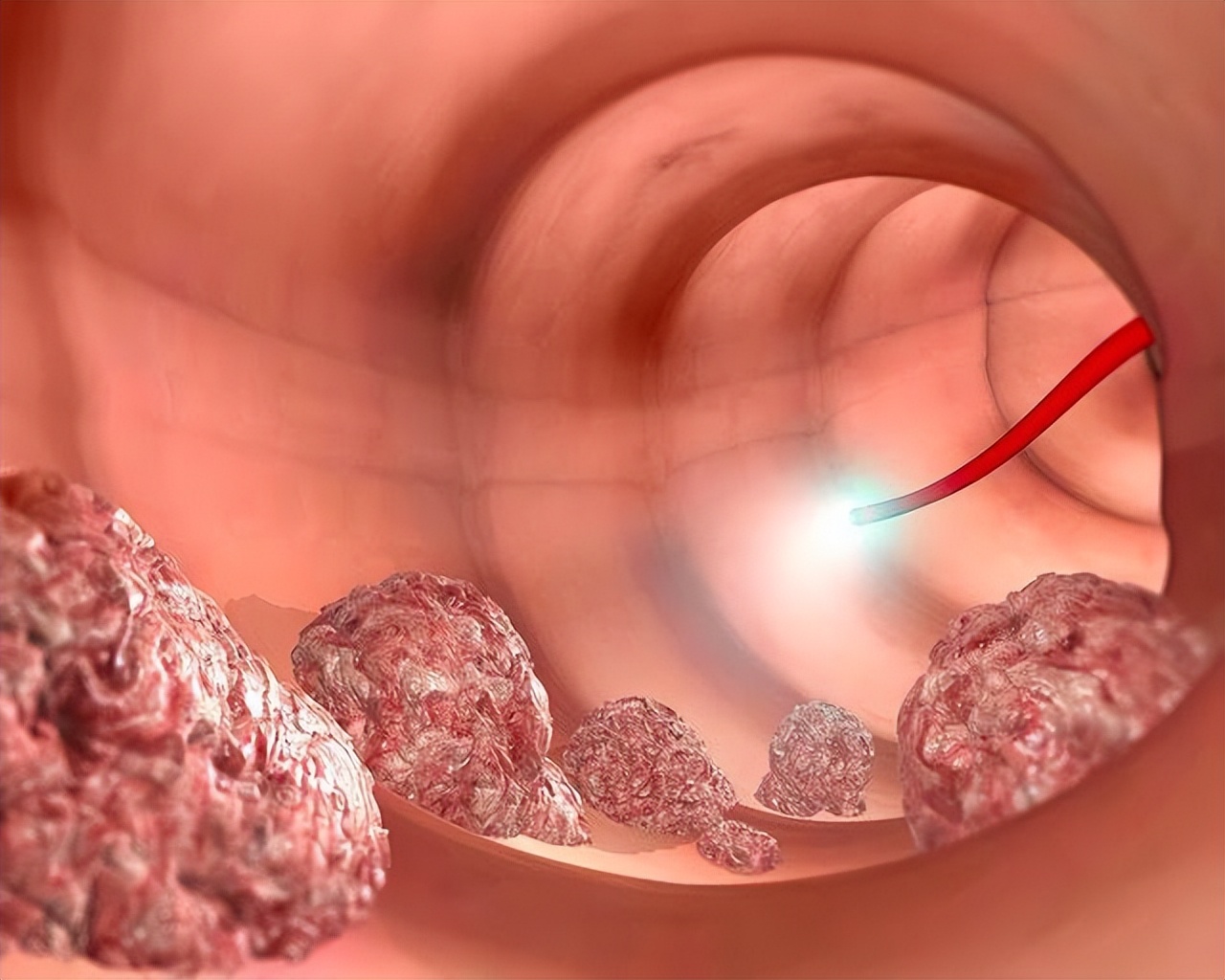 为什么肛肠科医生总是建议做肠镜,为啥多数人不敢做胃肠镜