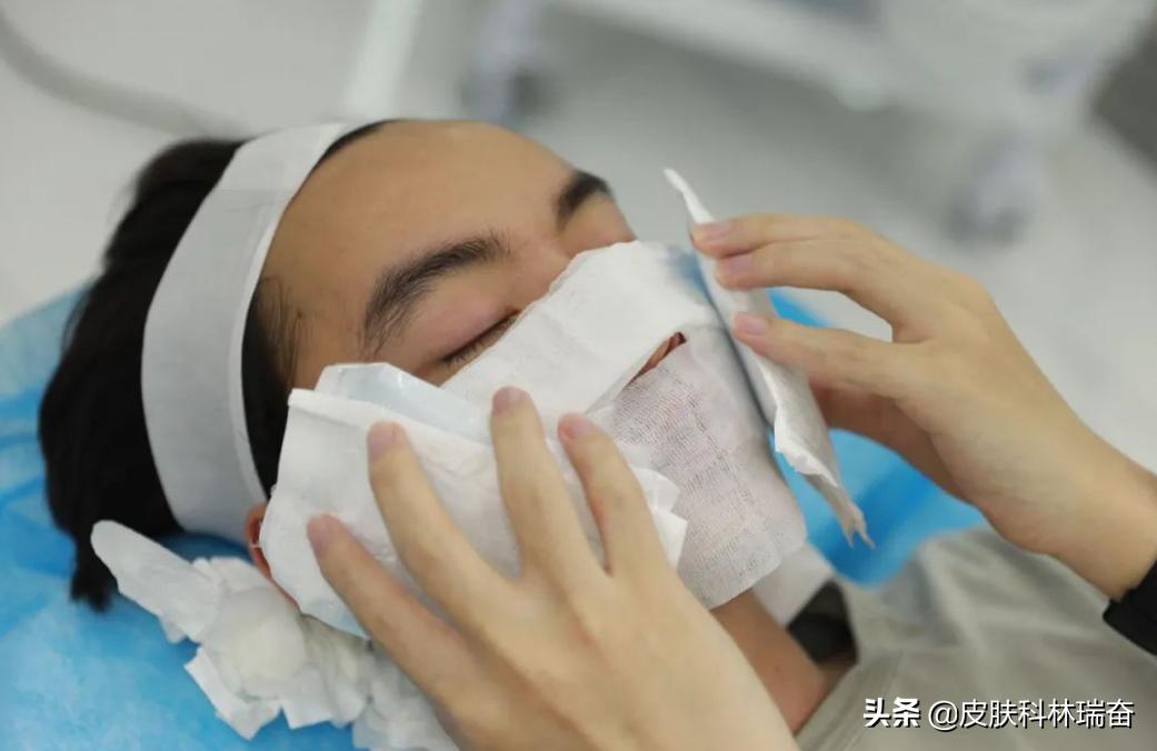 痘坑剥离激光点阵后长痘痘,脸上痘坑点阵激光治疗后效果图片