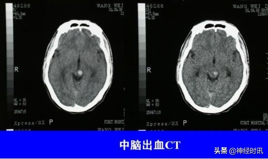 脑受撞击少量出血症状表现,脑动脉瘤出血的表现