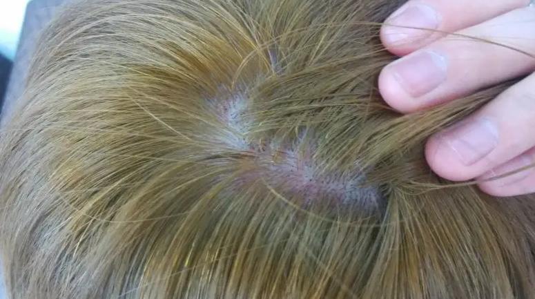 头皮总是长疙瘩是怎么回事,头皮上老长疙瘩怎么回事