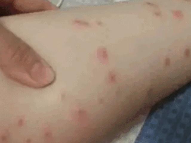 去公园可怕的虫子,去公园如何避免蚊虫叮咬