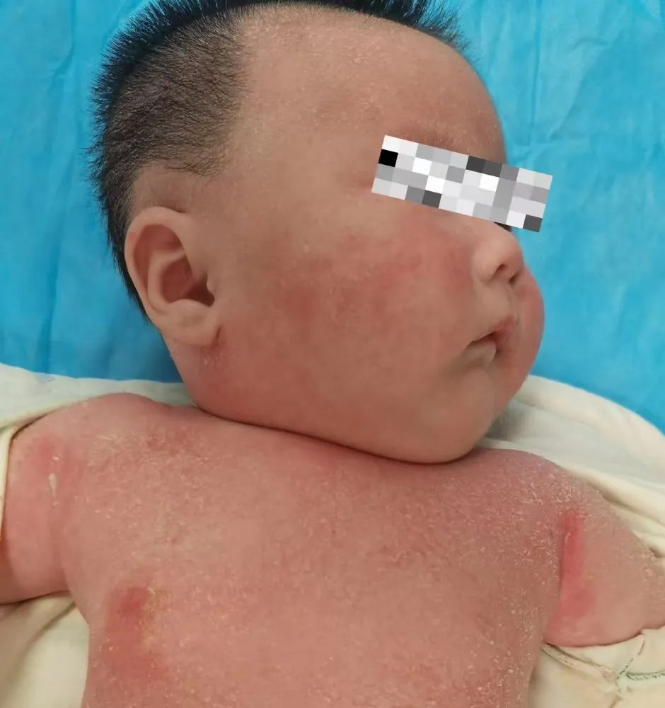 宝宝阳康之后一直咳嗽怎么办,儿童阳康后怎么护理