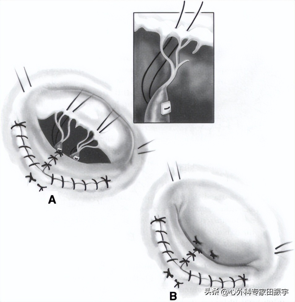 二尖瓣成形术要多少钱,二尖瓣成形术后抗凝多久