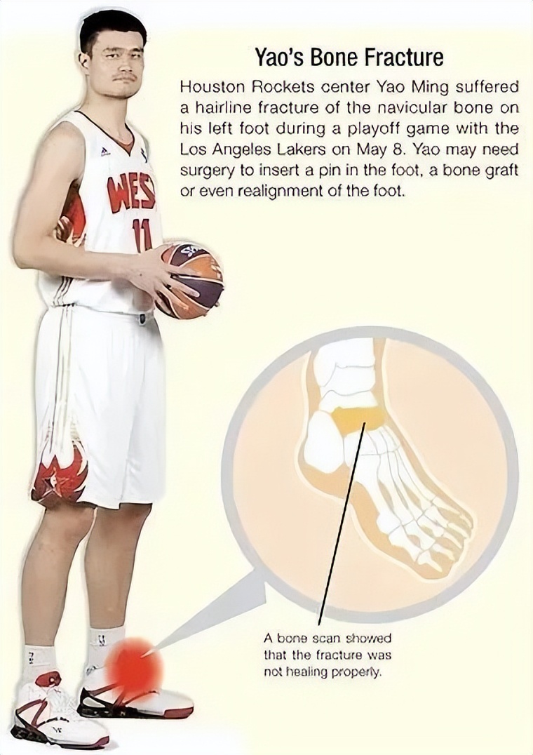 这种损伤，越是重复性的运动，风险越大