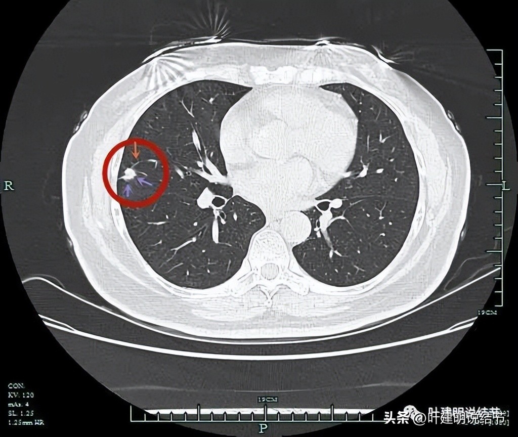 子宫内膜癌术后病灶大于二厘米,子宫内膜癌手术后一年又发现肺癌