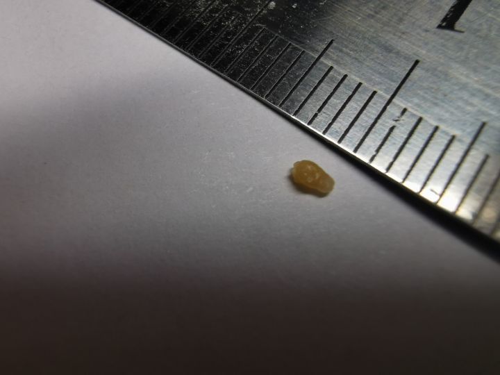 20年的黑头有多大,世界上最长的黑头到底有多长