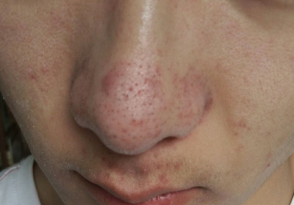 毛孔堵塞怎样才能疏通毛孔,身上毛孔堵塞不出汗怎么疏通毛孔