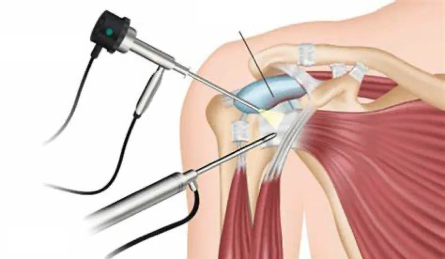 肩关节解剖及常见疾病的磁共振,肩关节常见病图解