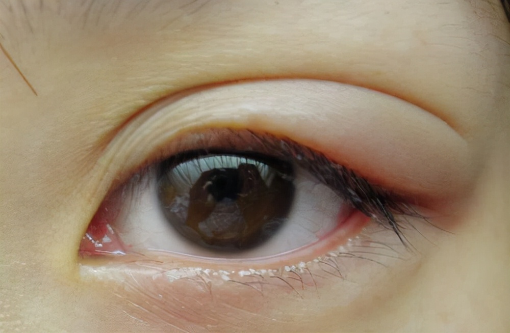 肾虚会导致眼睛水肿吗,眼睛水肿跟肾虚有关系吗