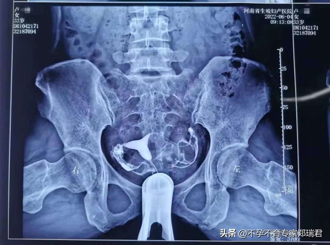 一侧输卵管不通能怀孕吗,输卵管一边通一边不通能怀孕吗