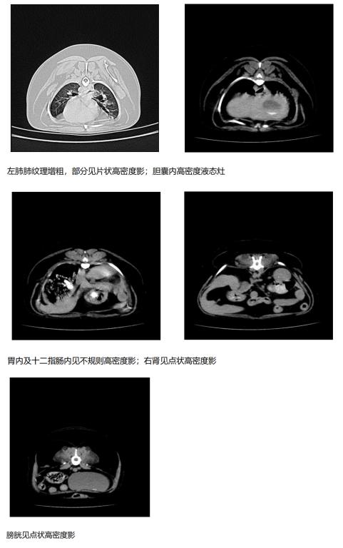射频理疗治疗椎间盘突出,激光治疗腰椎间盘突出的图片