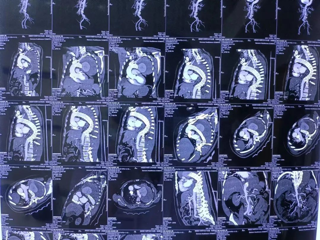 男子腹部剧痛检查意外肿瘤,男子腹痛难忍医生实施手术