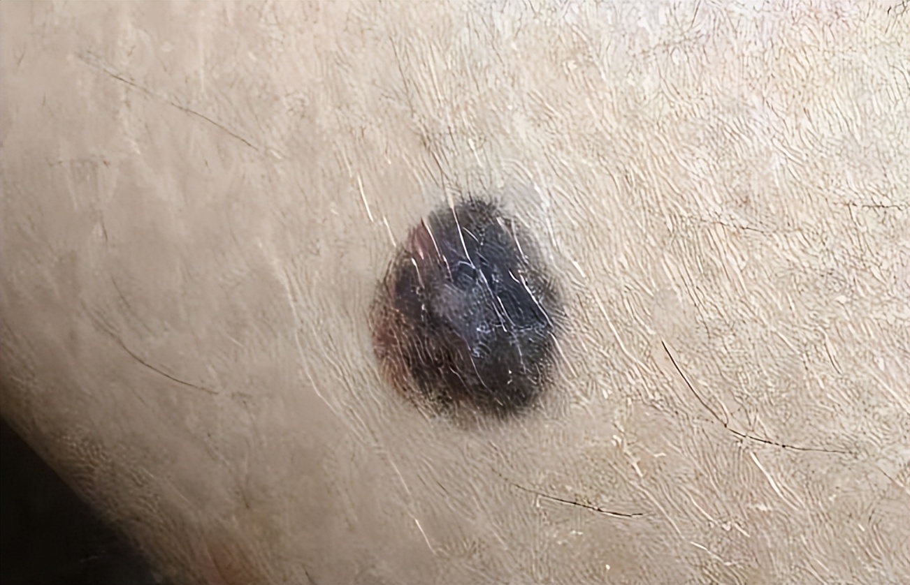 mrna技术预防黑色素瘤,松花粉可以预防黑色素瘤吗