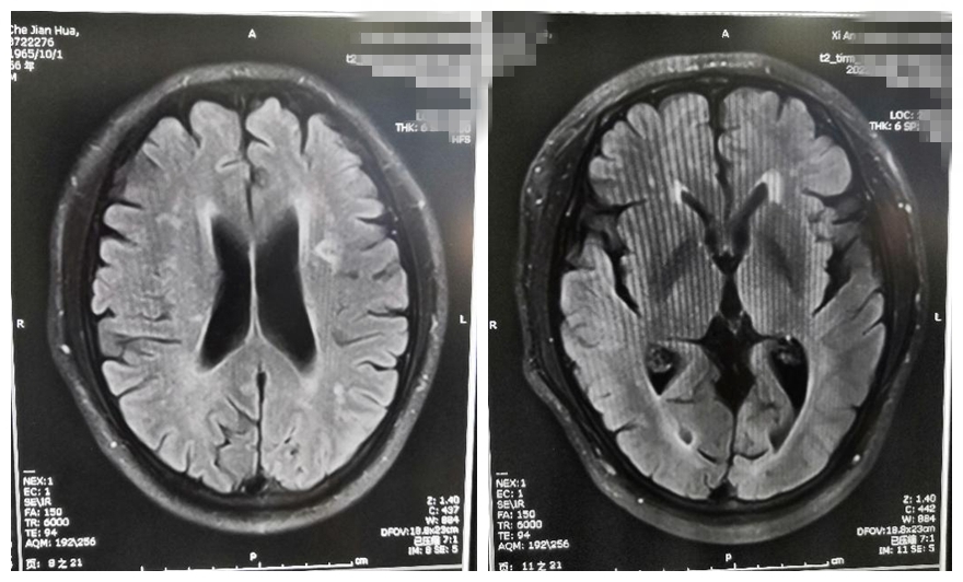 左侧大脑中动脉重度狭窄手术过程,颅内动脉重度狭窄能做手术吗