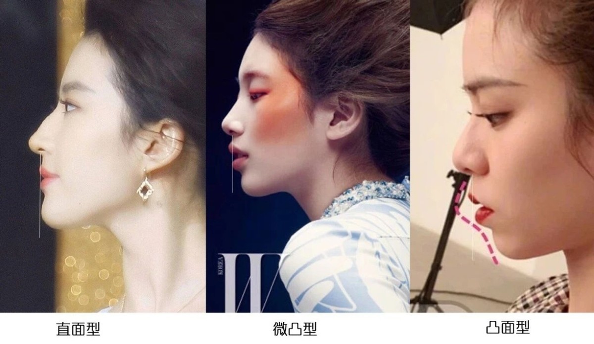 下巴短和后缩怎么变美,下巴后缩怎么矫正嘴尖