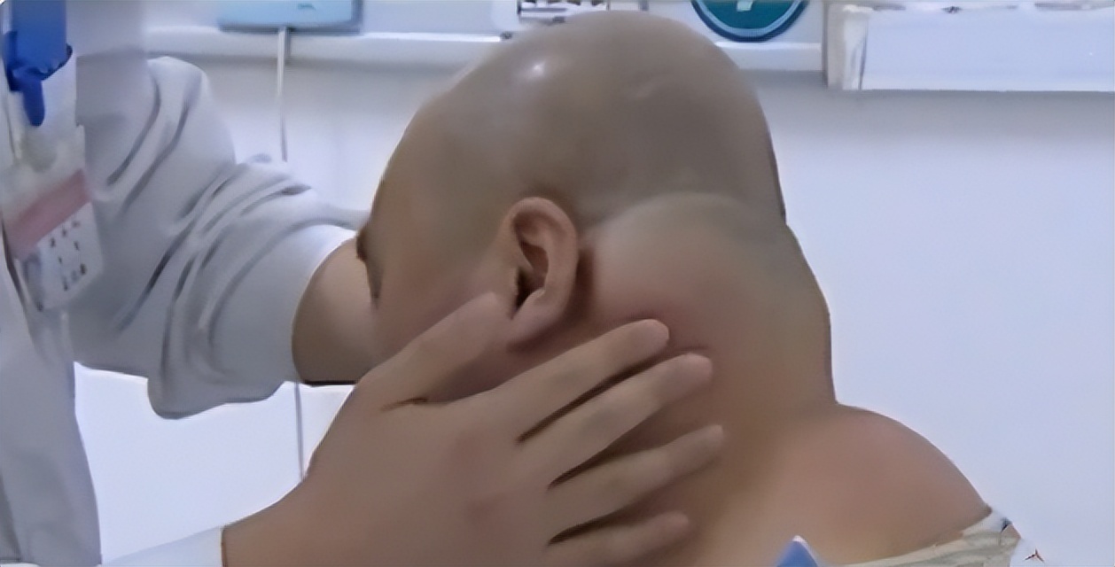 大叔喝酒30年喝出河马脖,辽宁大叔喝酒40年喝成河马脖