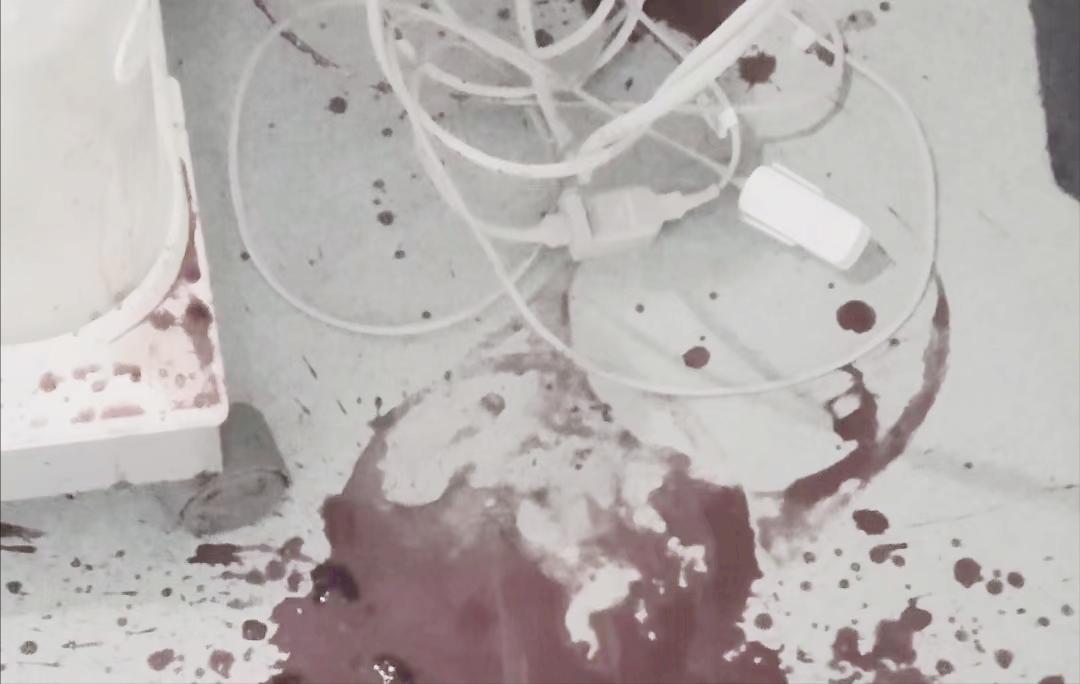 「病例分享」舌癌患者突发大出血，燥动不安，介入治疗成功止血