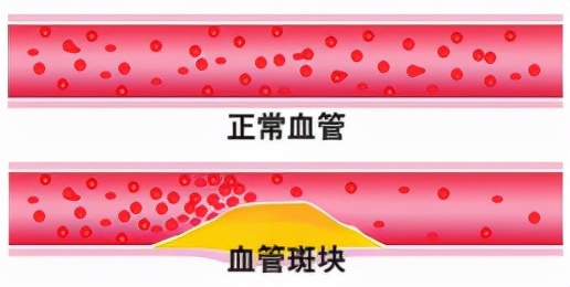 如何检查心梗和脑梗有问题,心梗脑梗可以查出来吗