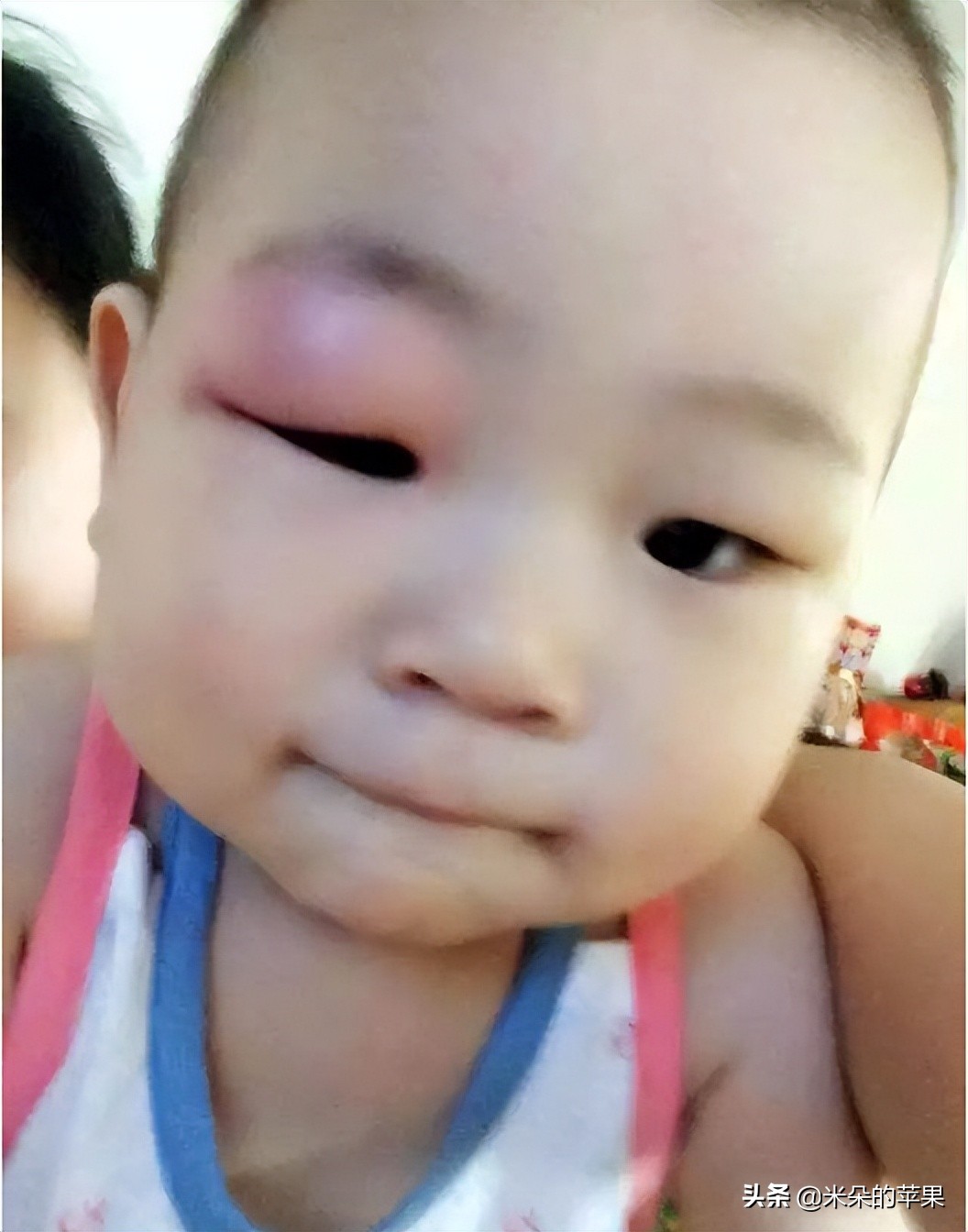 孩子被蚊子咬了很痒怎么办,孩子被蚊子咬痒得厉害怎么办