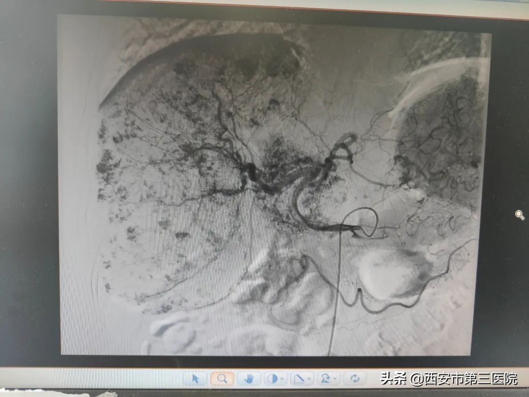 沈阳治疗肝血管瘤介入哪家医院好,肝血管瘤介入手术大概需要多少钱