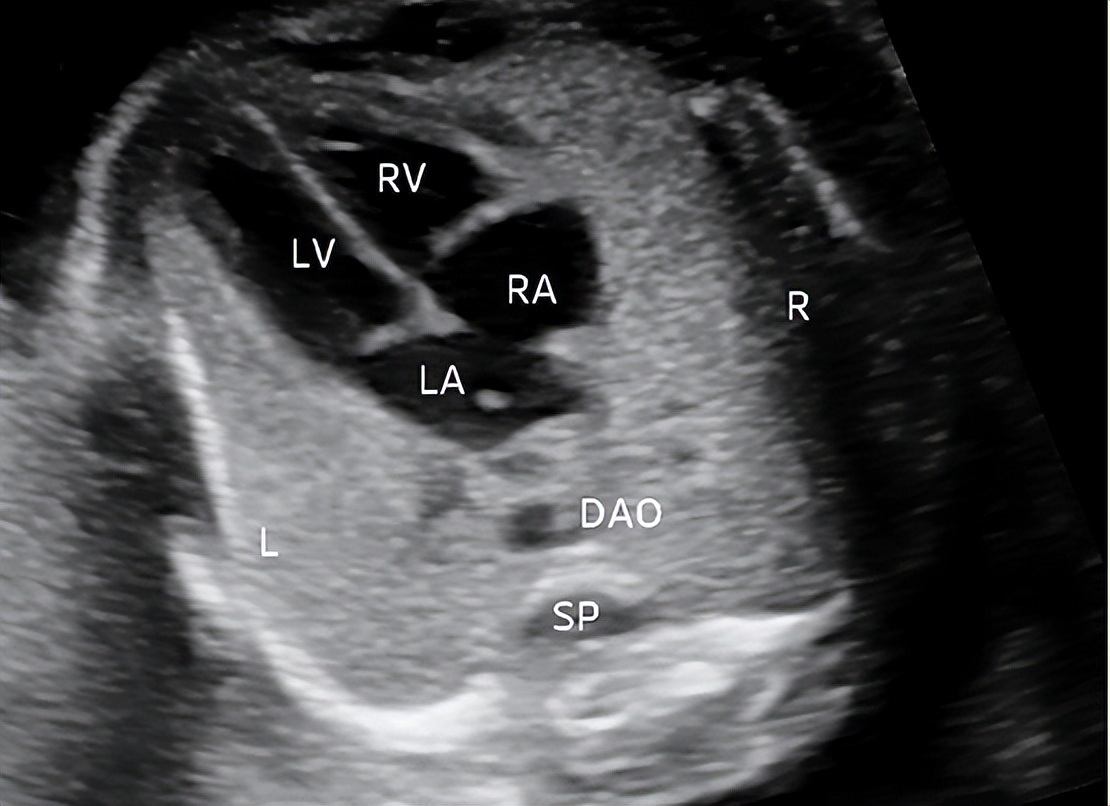 孕晚期i级产前超声检查是什么,孕中期超声产前检查