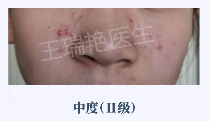 怎么区分不同种的痘痘,如何分清自己的痘痘是什么类型