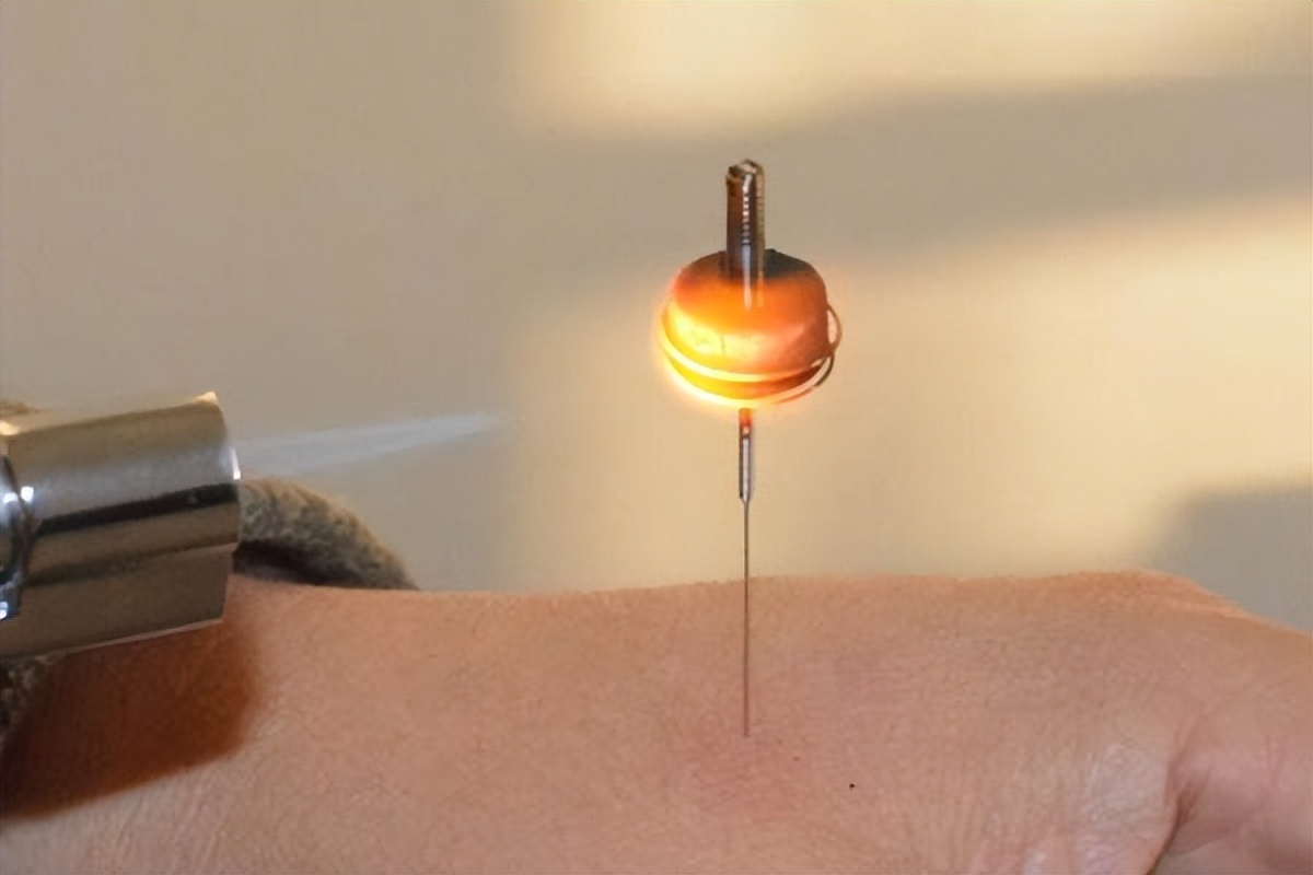 基于气血津液理论,探析阳虚质膝骨性关节炎的中医治疗