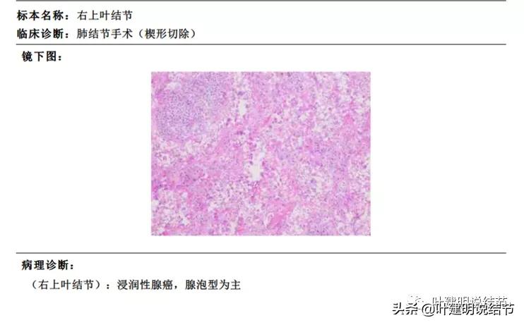 肺多发结节切除一个剩下的怎么办,无限纠结的肺小结节