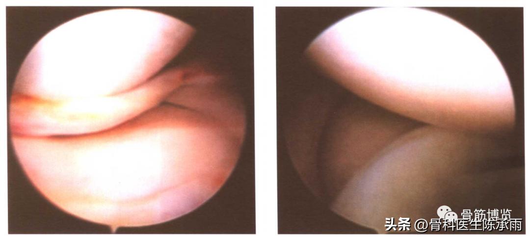 盘状半月板撕裂一级,半月板层裂愈合概率