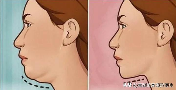 抽脂针瘦脸,抽脂溶脂针