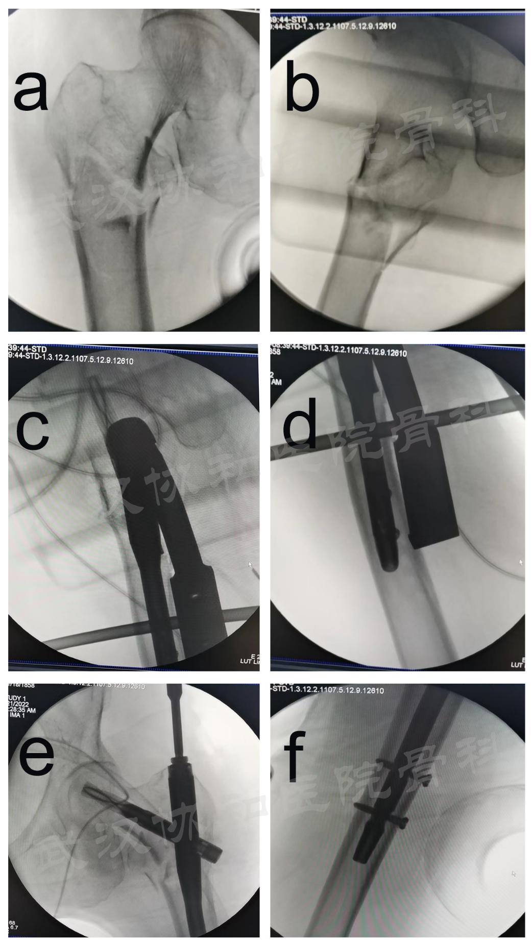 双导牵引矫正器,反向牵引复位固定器