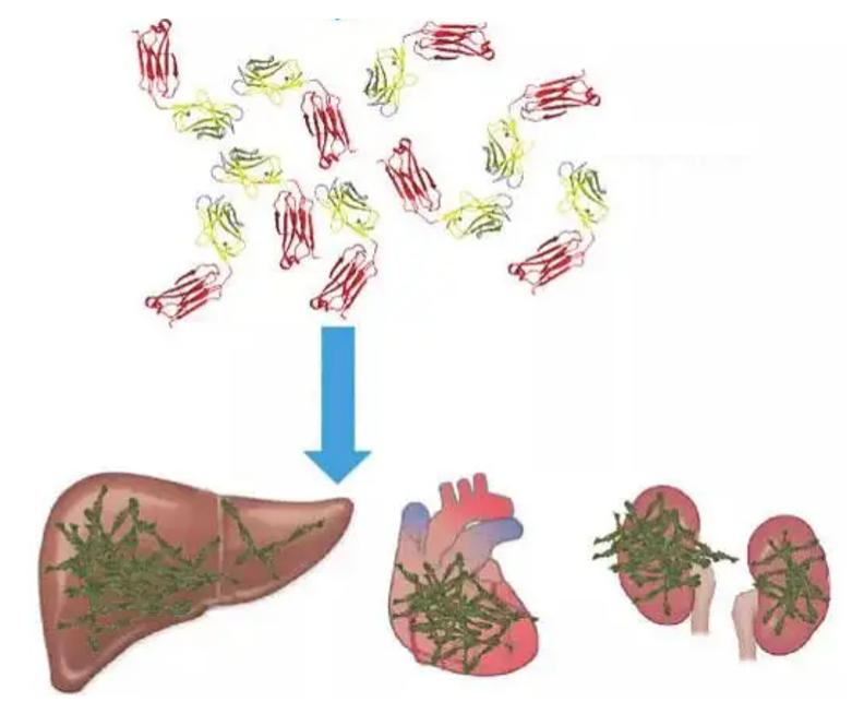 淀粉样变肾损害是什么意思,肾淀粉样变性的发病原因